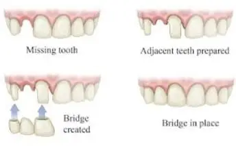 sidcupdentalspa_before-after-bridges