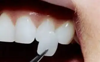 sidcupdentalspa_before-after-veneers