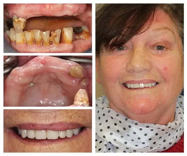 Full mouth dental implants