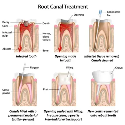 sidcupdentalspa_root-canal treatment