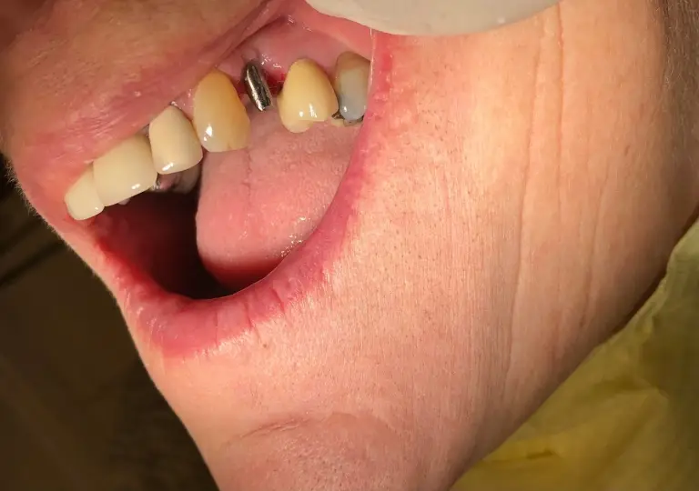 Dental Implants Before