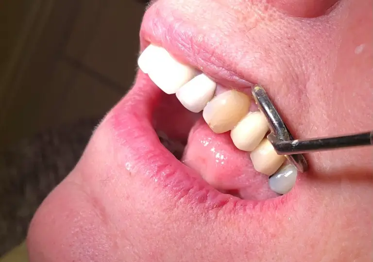 Dental Implants After