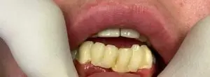 Dental Implants Before
