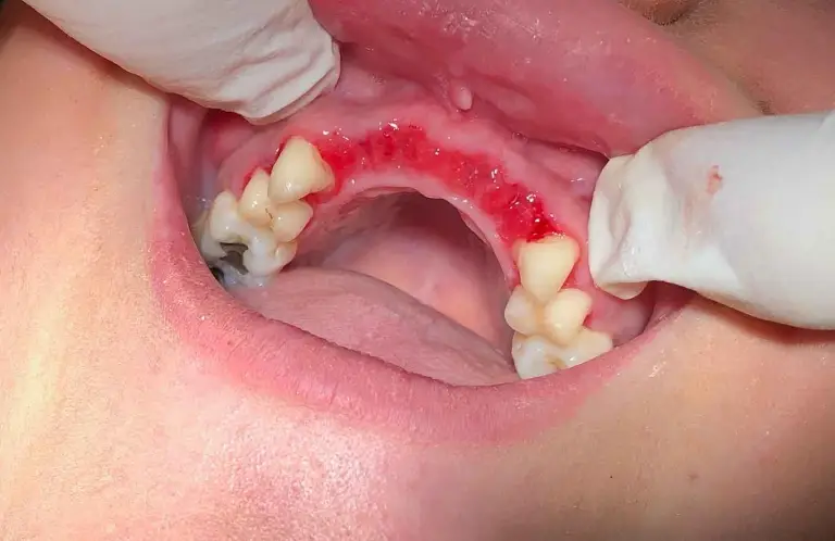 Dental Implants Before