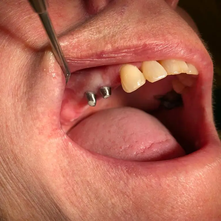 Dental Implants Before