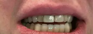 Dental Implants After