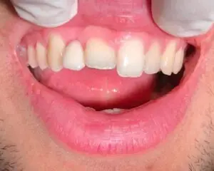 Dental Implants After