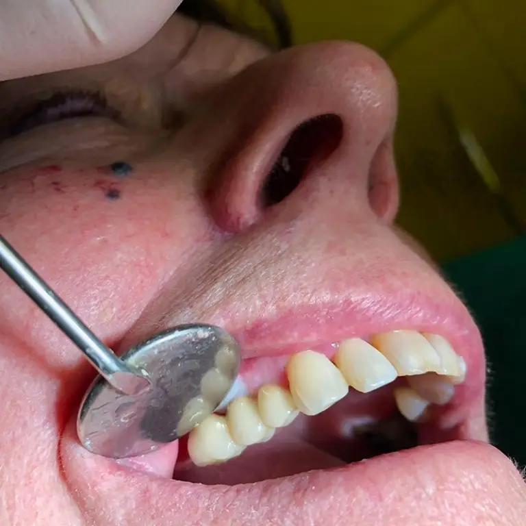 Dental Implants After