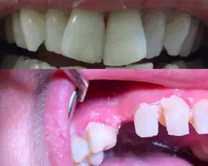 Dental Implants Before & After