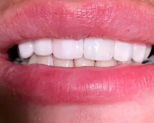 Dental Implants After