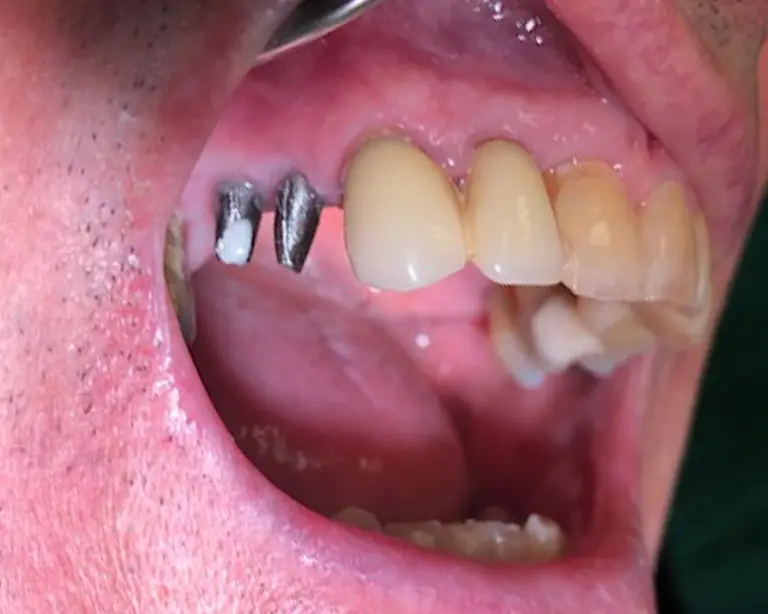 Dental Implants Before