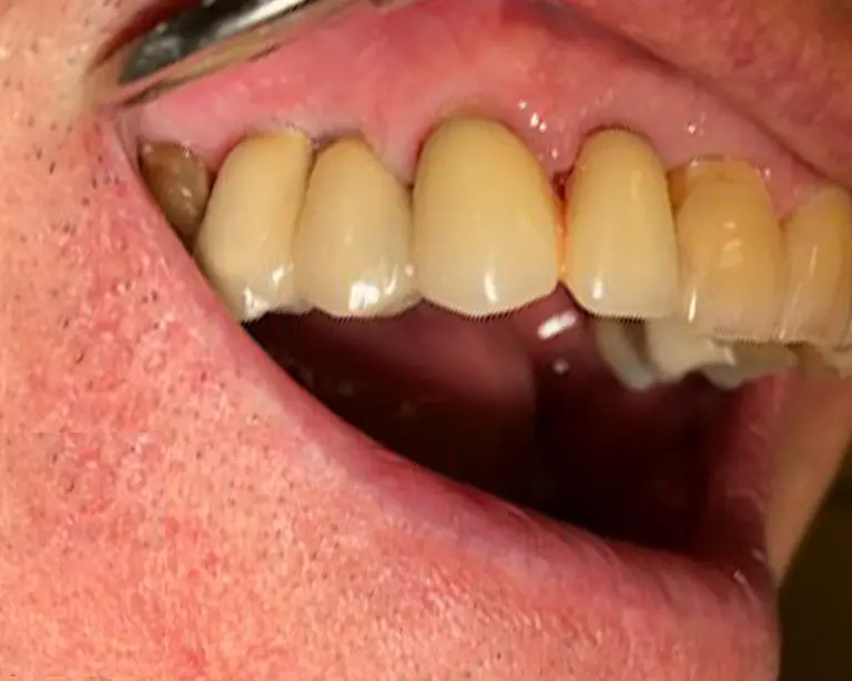 Dental Implants After