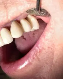 Dental Implants After