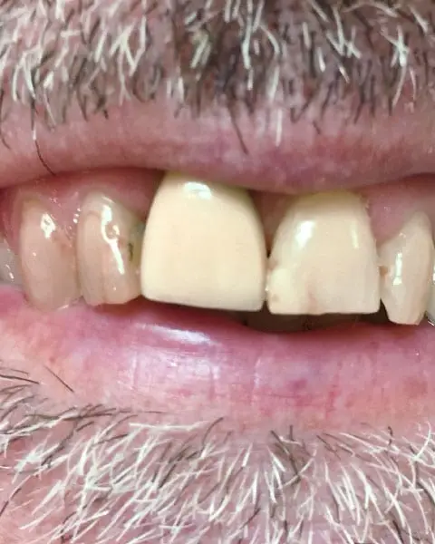 Dental Implants After