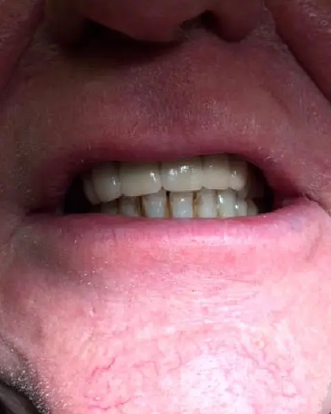 Dental Implants After
