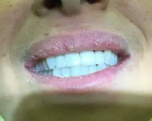 Dental Implants After