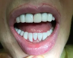 Dental Implants After