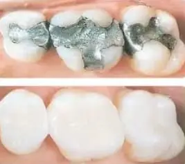 Before and after images showing the transformation with white dental fillings, highlighting improved aesthetics and restored tooth appearance.