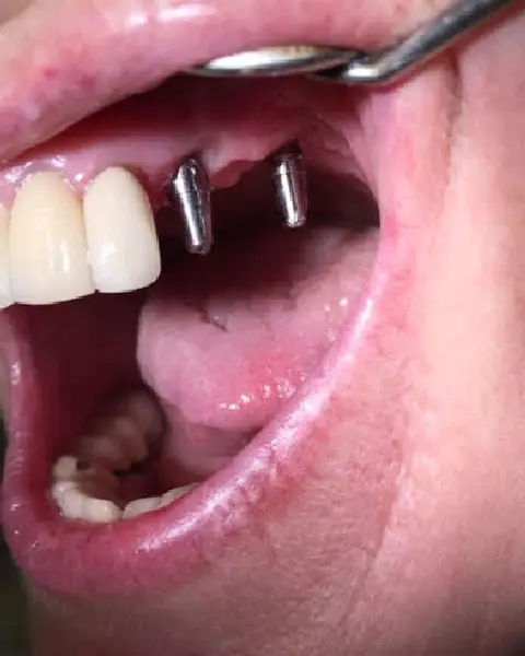 Dental Implants Before