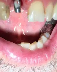 Dental Implants Before