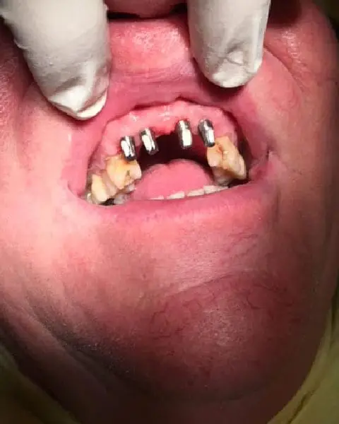 Dental Implants Before