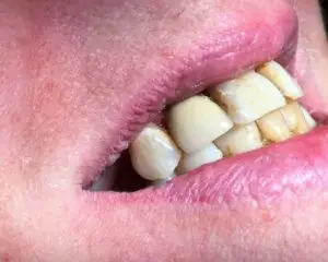 Dental Implants After