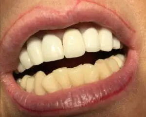 Dental Implants After