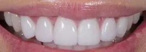 Dental Implants After