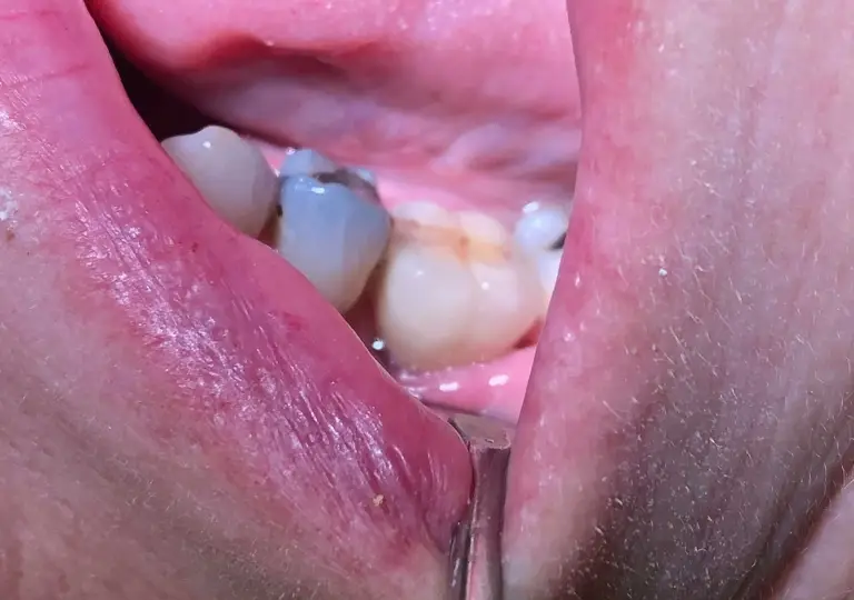 Dental Implants After