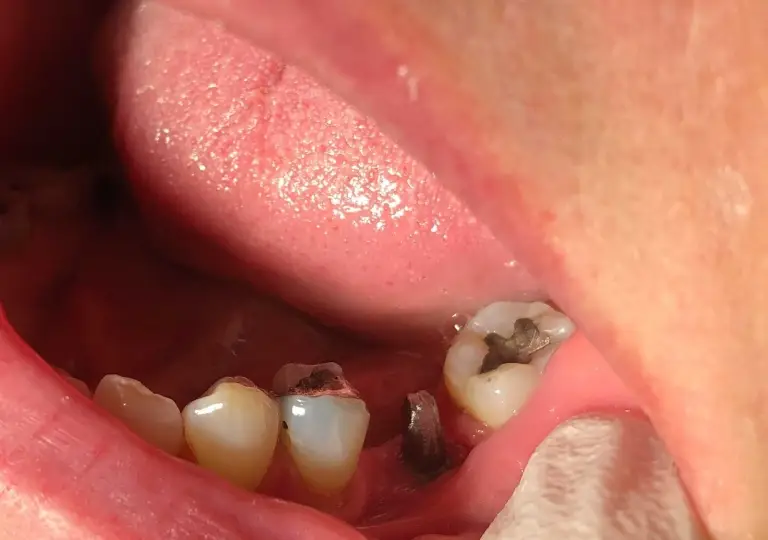 Dental Implants Before