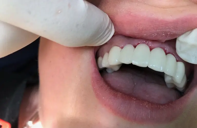 Dental Implants After