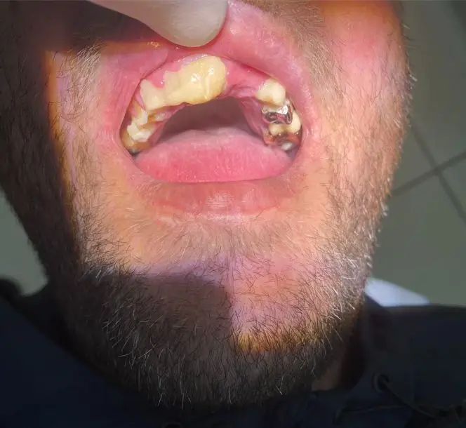 Dental Implants Before