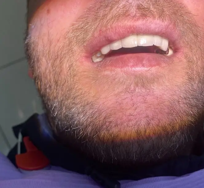 Dental Implants After