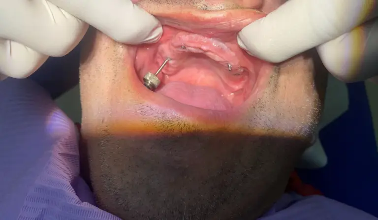 Dental Implants Before