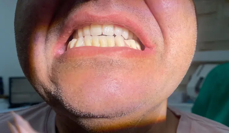 Dental Implants After