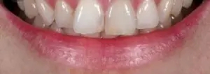 Dental Implants After