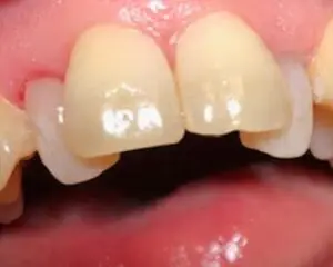 Dental Implants After
