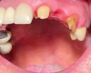 Dental Implants Before