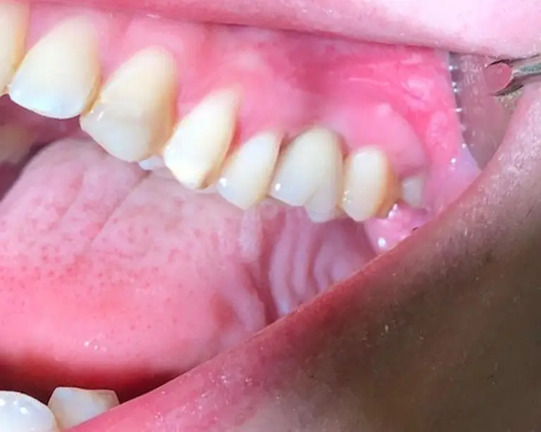 Dental Implants After