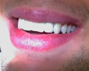 Dental Implants After