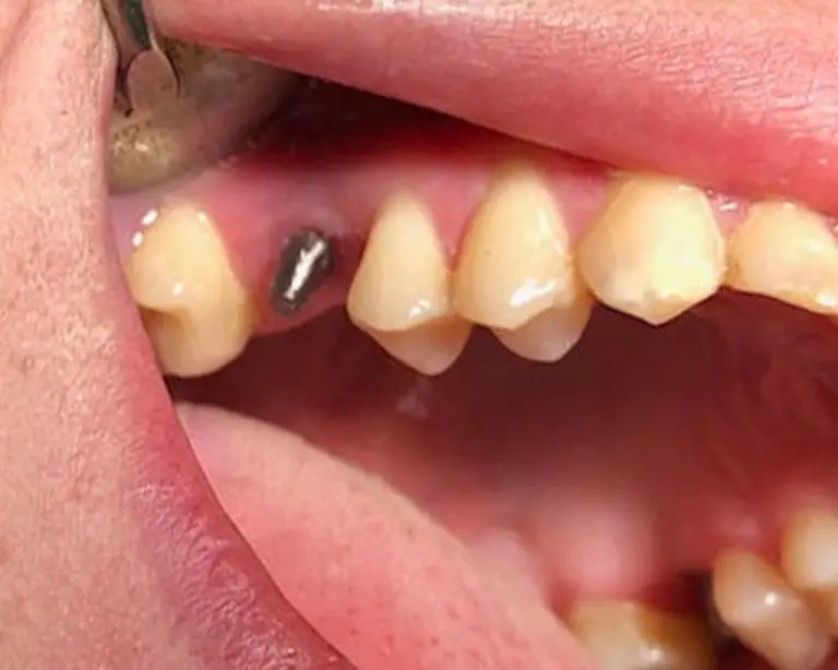 Dental Implants Before