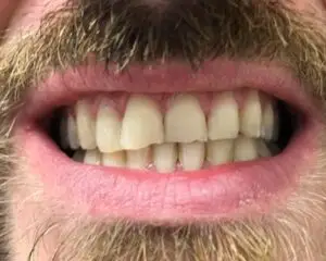Dental Implants After