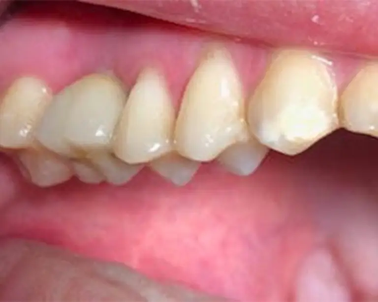 Dental Implants After