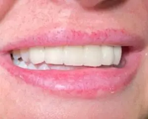 Dental Implants After