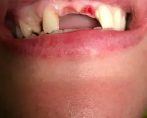 Dental Implants Before