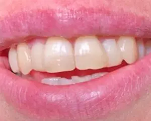 Dental Implants After