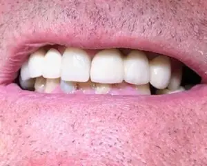 Dental Implants After