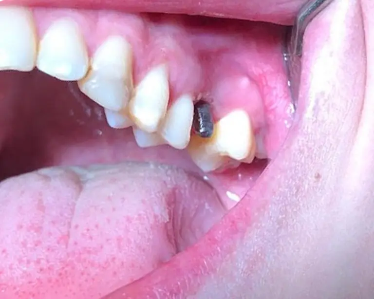Dental Implants Before