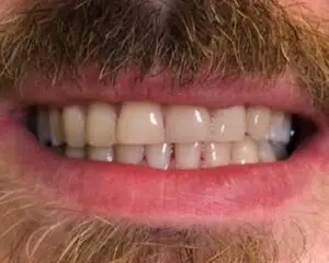 Dental Implants After