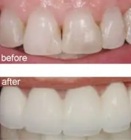 Before and after whitening